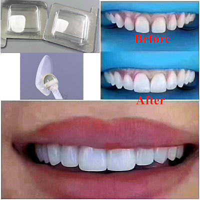 #ad Teeth Veneer Dental Veneers Tooth Whitening Ceramic Anterior LMS
